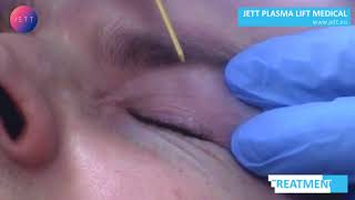 JETT PLASMA fibroma removal