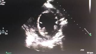 Echo Practice - wall motion abnormality