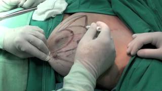 Operation 13 -  Batwing Oncoplastic Resection 9m