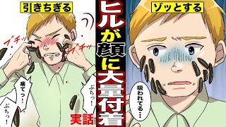 【実話】大量のヒルを顔面に貼り付けてニキビ治療した男！顔からヒルを無理やり引きちぎった男の末路とは？（マンガ動画）