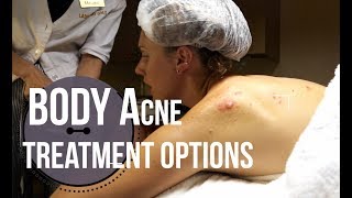 Body Acne Treatment Options : What To Ask For At A Med Spa