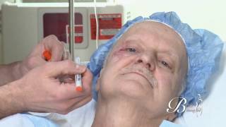Facial burn reconstruction