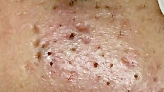 Amazing Blackheads Remover #10