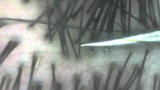 Comedo of the pore of a scalp (back of the head)