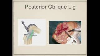 Getting a varus knee straight: Tips tricks and Traps - Dr. Vaibhav Bagaria