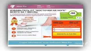 вальгусная деформация 1 пальцев стоп опе

  - рекомендую лечение hallux valgus косточки