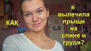 Как я вылечила прыщи на спине и груди?