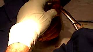 Jasons finger surgery