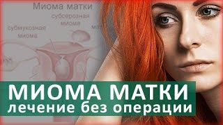 Лечение миомы матки. Методы лечения миомы матки. ЦЭЛТ
