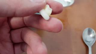 Denticor - predstavenie zubných náhrad časť 2