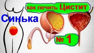 Как лечить цистит в домашних условиях! Лечение цистита синькой - синька при цистите | ed black
