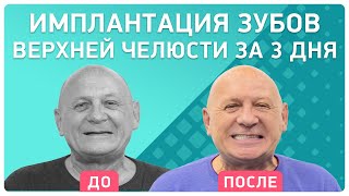 Имплантация верхней челюсти и съемный протез на нижней. Отзыв пациента об имплантации за 3 дня