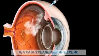 Интравитреальные инъекции – (Anti VEGF, Eyelia, Lucentis). Зачем, почему, как?