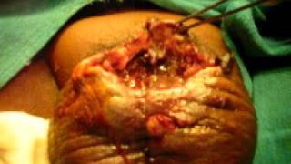 Penile cancer with maggots