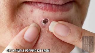 Best Chin Blackheads of All Time - Dilated Pore of Winer
