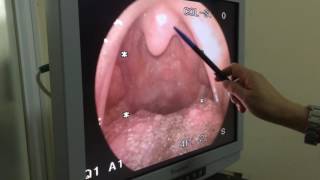 Nội soi Tai Mũi Họng tiến sĩ Vân part2