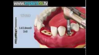 Zimmer implant