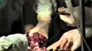 Хирургия повреждений -- политравма  -  Multiple injuries