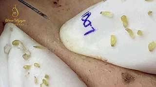 Skin care_ REMOVAL BLACKHEADS (89) | Loan Nguyen