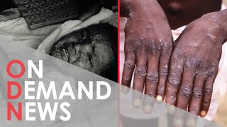 Monkeypox Outbreak: Should We Be Alarmed?