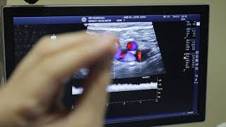 Varicose Veins left Sapheno Femoral Junction assessment Color Doppler Sonography