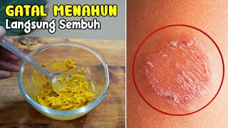 TAK USAH PAKAI OBAT LAGI, GATAL-GATAL MENAHUN LANGSUNG SEMBUH SELAMANYA 