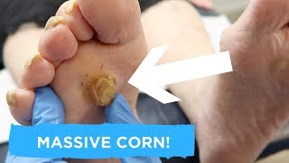 MASSIVE CORN TREATMENT