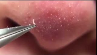 Выдавливание черных точек на носу/Squeezing blackheads