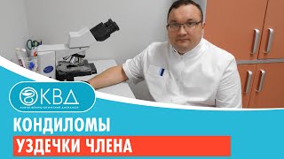 Кондиломы уздечки члена. Клинический случай №22