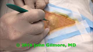 Big White Mushroom Cyst!  Popping Biggest Back Zits!