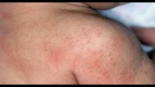 Cara Mudah Menghilangkan Alergi