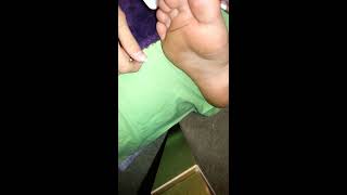 Needle in foot