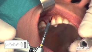 Astra Tech Implant System EV - Maxillary premolar single tooth case