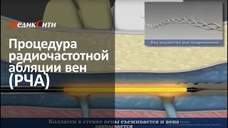 Хроническая венозная недостаточность и процедура радиочастотной абляции вен (РЧА)