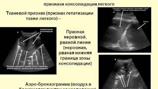 УЗИ в диагностике дыхательной недостаточности Лахин Р. Е. (ICRS 2013  Красноярск)