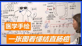结直肠癌：网红女医生漫画科普结直肠癌