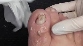 Mais um atendimento ? onicocriptose (unha encravada)