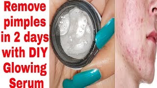 REMOVE PIMPLES IN 2 DAYS|100% effective|बार बार एक ही जगह पर pimples क्यो होते है?|DIY pimple serum