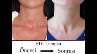 İP İle Yüz Germe FTC ÖRÜMCEK AĞI