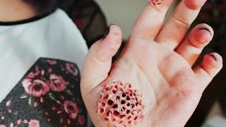 Maggot Infested Hand