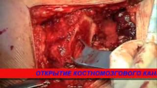 Эндопротезирование тазобедренного сустава.
