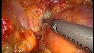 VATS Thymectomy 5