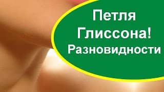 Петли Глиссона.  Типы.  Разновидности. Тольятти.