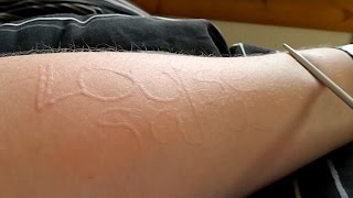 Rare Condition Allows Woman to Draw on Her Skin Without Ink