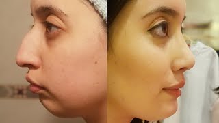 MI EXPERIENCIA COMPLETA | CIRUGIA MULTIPLE DE ROSTRO