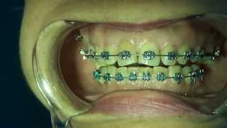 TAD - MICRO IMPLANTES INSTALACIÓN