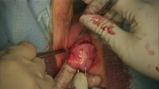 Total Vaginal Hysterectomy and McCall Culdoplasty
