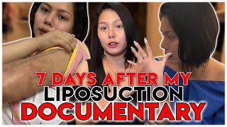 VLOG 049 INSTANT PAYAT | 1 WEEK POST OP | LIPOSUCTION