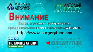 Имплантация Гидравлического протеза полового члена с лобковым доступом