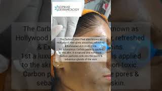 Hollywood Peel/ Carbon Peel